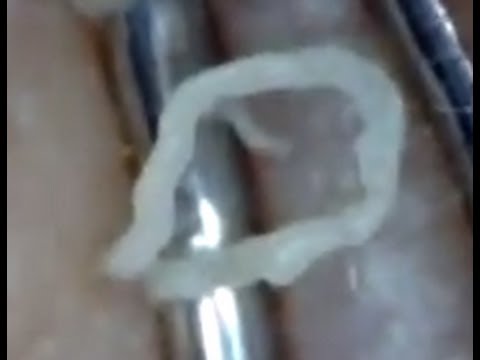 how to pop a zit under your skin