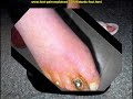 diabetic foot ulcer treatment