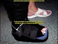 diabetic foot ulcer treatment