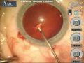 Cataract Extraction: Crystalens