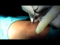 Sebaceous Cyst Back Drained Properly