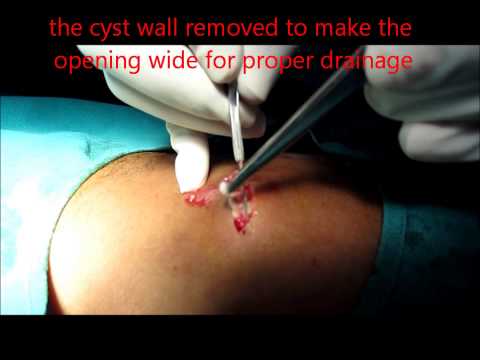how to drain epidermal cyst