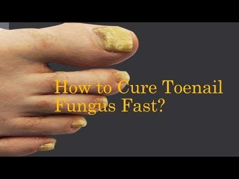 how to cure toe fungus quickly