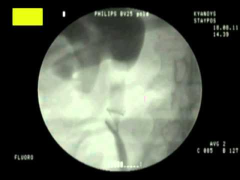 how to repair ureteral injuries