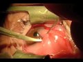 Pterygium Excision