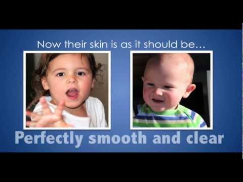 how to treat babies with eczema