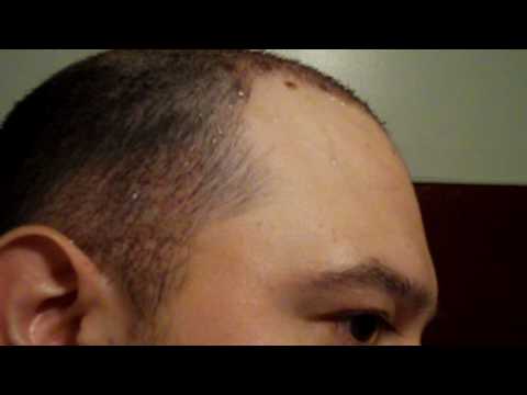how to remove scabs after hair transplant