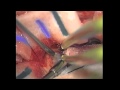 Cervical ependymoma resection