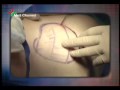 Liposuction live operation by the...