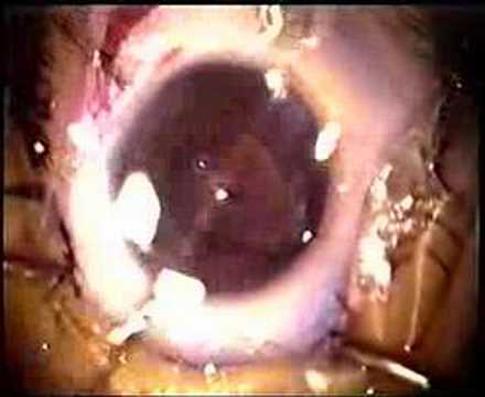 PAEDIATRIC CATARACT