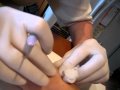 Cyst asperation Can i smell it? Extremely gross and funny