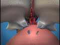 Weill Cornell Robotic Prostatectomy: 3-D Animation (2/6)