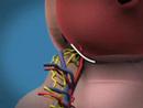 Weill Cornell Robotic Prostatectomy: 3-D Animation (2/6)