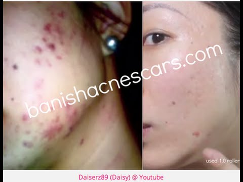 如何消除痘疤痘印？Banish Acne Scars 消除痘印专家  正式登录亚洲