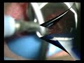 Subglottic Wegener's Granulomatosis Wegener's Granulomatosis