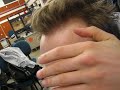 Hair transplant #1 - 7 months