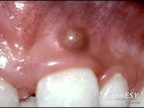 how to relieve gum abscess pain
