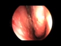 Endoscopy of Nasal Cavity and Sinuses Endoscopy of Nasal Cavity and Sinuses