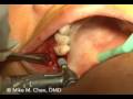 Implant Placement - Using Up-Fracture Technique Implant Placement - Using Up-Fracture Technique