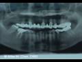 videos de Implant Placement - Using Up-Fracture Technique