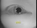 positional nystagmus 5