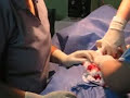 Cirug�a de las trompas de falopio