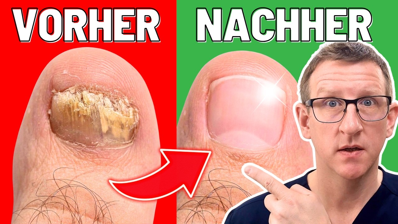 Nagelpilz - dieses Hausmittel wirkt BESSER als Chemie!