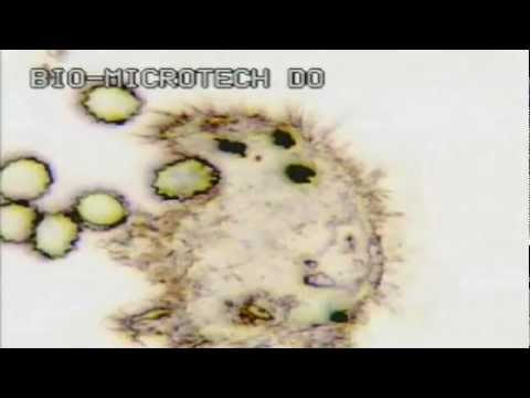 Pathology: Malaria. Extract from the DVD “A Miniature Universe, Matter, Motion & Mind”, by B. Chikly