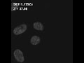 Chromosome of lung cancer cells treated with lonafarnib (S1)