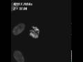 Chromosome of lung cancer cells treated with lonafarnib (S1)