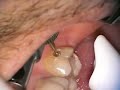 Laser Caries Removal Technique
