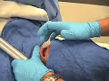 Intubation-How to perform endotracheal intubation # 2