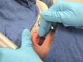 Intubation-How to perform endotracheal intubation # 2