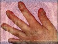Candida And Lung Infection