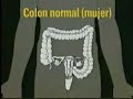Problemas del Colon