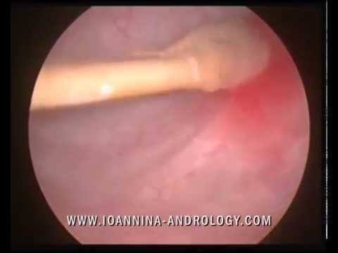 how to perform urethral swab