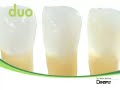 Ceram X duo: Presentaci�n T�cnica