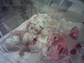 Presley - Battle with Neonatal Lupus
