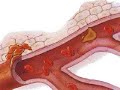 Metastasis