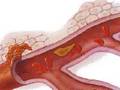 Metastasis