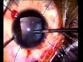 Management of traumatic rupture of the posterior capsule Manele-Gratis.net