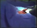 Plastibell Circumcision