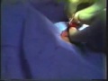 Plastibell Circumcision