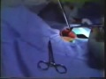 Plastibell Circumcision