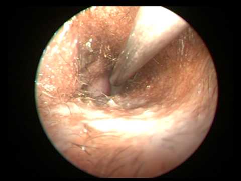 how to relieve otitis externa pain