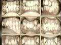 NEW BRACES