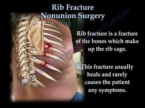 how to treat broken ribs