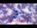 This is a video about Platelet Rich Plasma and its use for acute and chronic tendon disorders such as tendonitis and tendon tears.