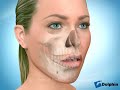 Surgical Correction of Open Bites