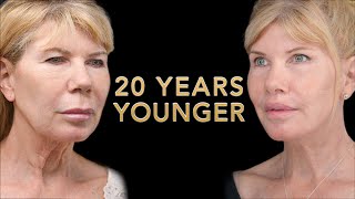 Her Husband Thought She Was A Younger Woman After Plastic Surgery! Ponytail Facelift™